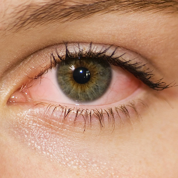 How Long Does Pink Eye Last? Viral vs. Bacterial Pink Eye
